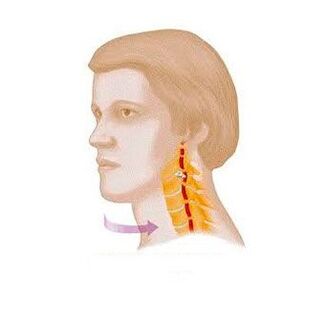 Síndrome vertebral con osteocondrosis cervical. 