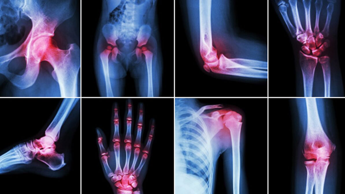 Radiografía para el dolor articular