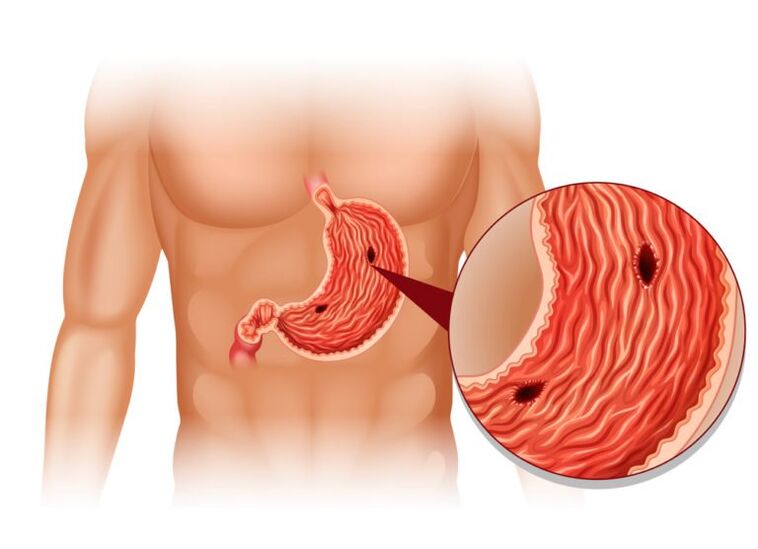Úlcera como causa del dolor debajo del omóplato izquierdo en la espalda