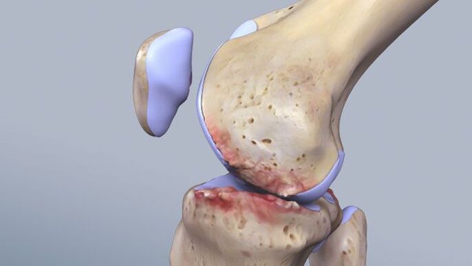 La estructura de la articulación de la rodilla se ve afectada por la patología. 