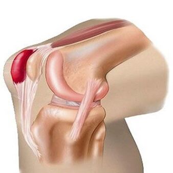 Una de las causas del dolor en la articulación de la rodilla es la bursitis. 