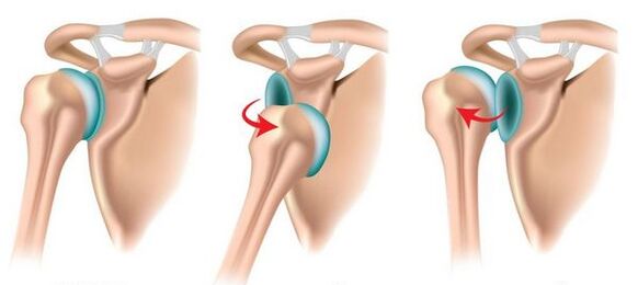 Luxación anterior y posterior de la articulación del hombro, que conduce al desarrollo de artrosis. 