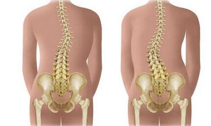 Escoliosis no resistente