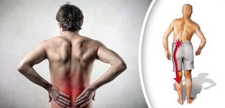 El síndrome de dolor con osteocondrosis lumbar exuda en las piernas
