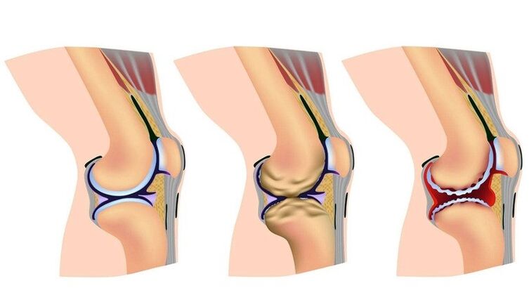 Etapas de deformación en la articulación de la rodilla a la artrosis