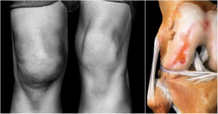 Osteoartritis de la articulación de la rodilla y la articulación del dolor