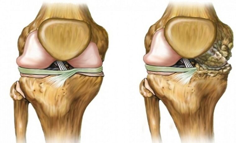 Saludable y afectado por la articulación de la artrosis