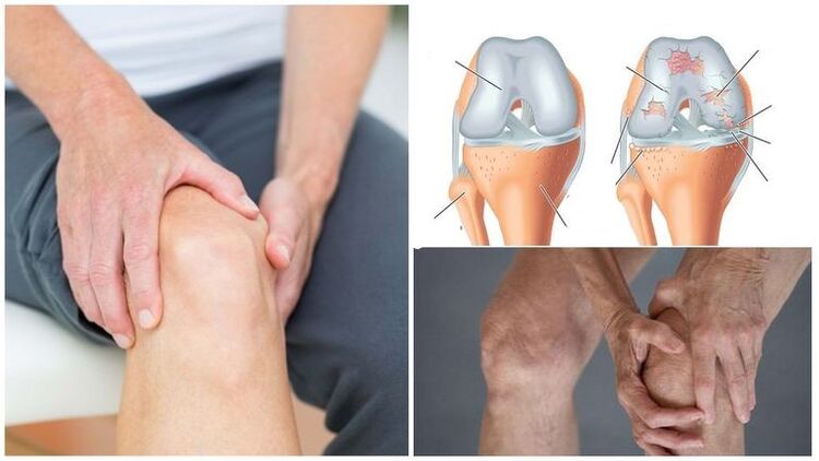 Síntoma de dolor de rodilla para la osteoartritis de la articulación de la rodilla
