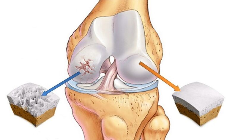 cartílago normal y osteoartritis