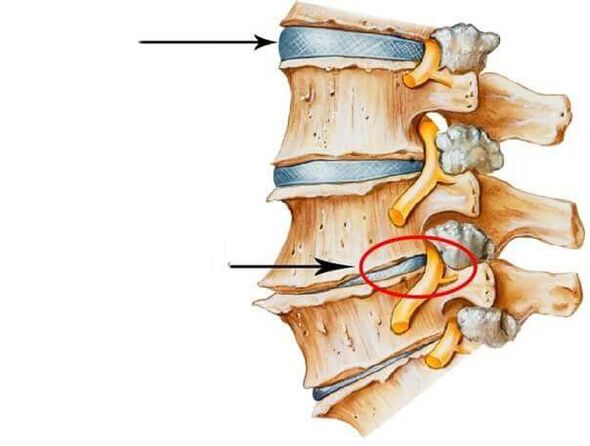 disco intervertebral normal y dañado en la columna