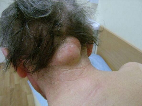 Hinchazón en el cuello como causa de dolor.