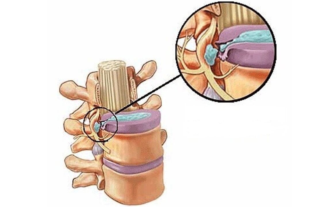Hernia intervertebral con osteocondrosis torácica.