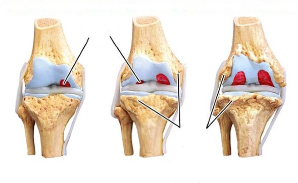 Etapas de la artrosis de rodilla