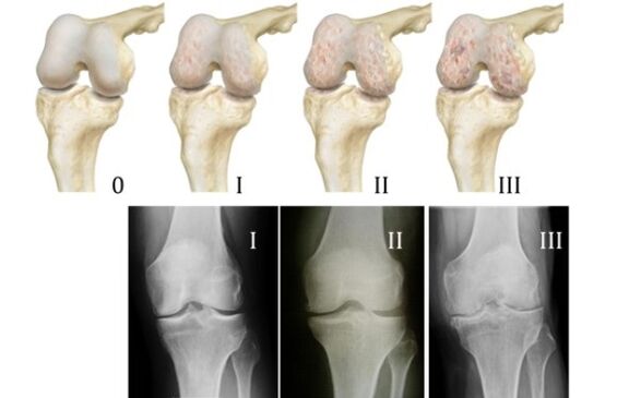 Métodos para diagnosticar la osteoartritis de rodilla.