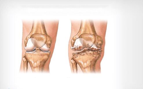 Osteoartritis de la articulación de la rodilla.